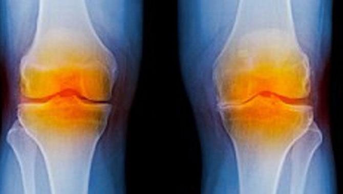 Facts About Knee Replacement